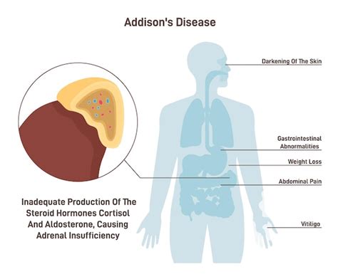 addidon|Doença de Addison: sintomas, diagnóstico,。